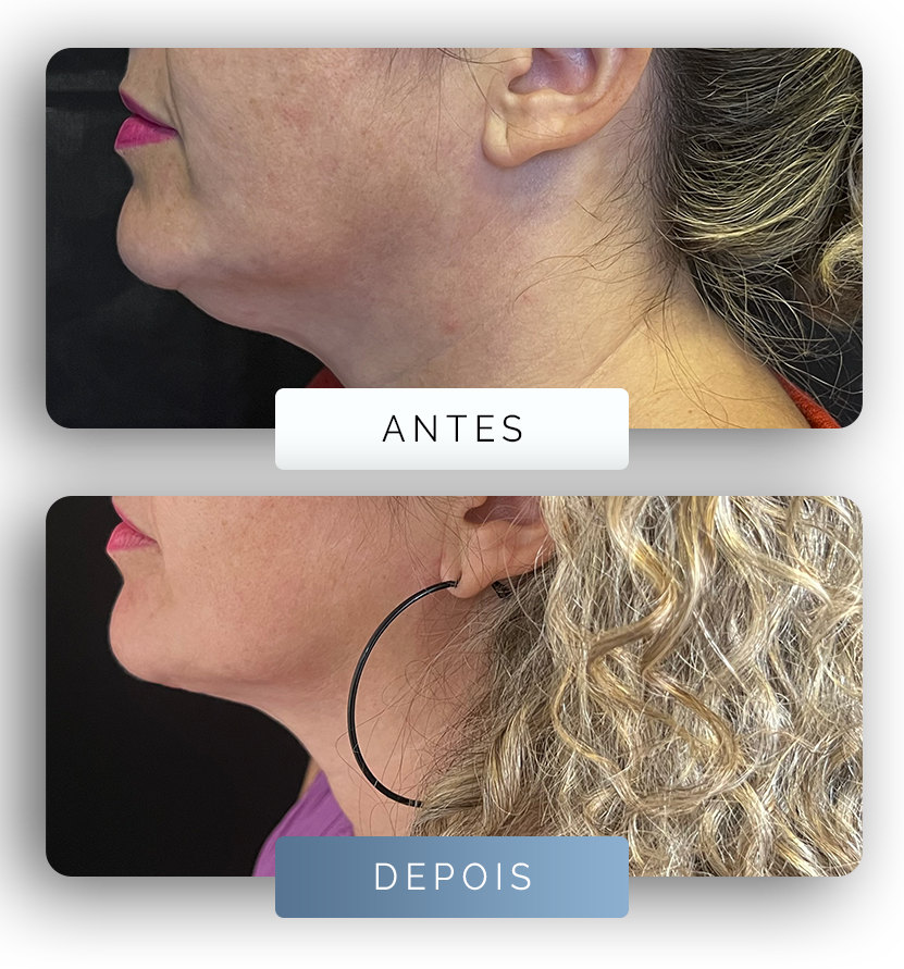 Página - Antes e depois 1