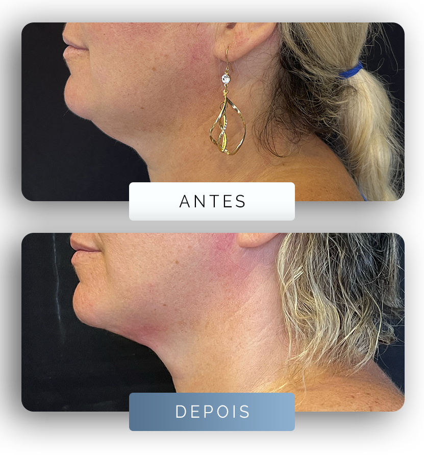 Página - Antes e depois 2